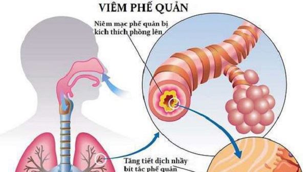 Mắc viêm phế quản mãn tính vì thường xuyên tiếp xúc với khói, bụi, ô nhiễm không khí – làm sao để phòng ngừa?