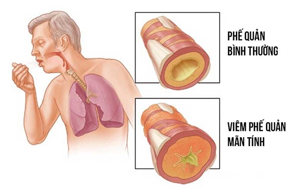 Làm sao để giảm triệu chứng bệnh viêm phế quản mãn tính?