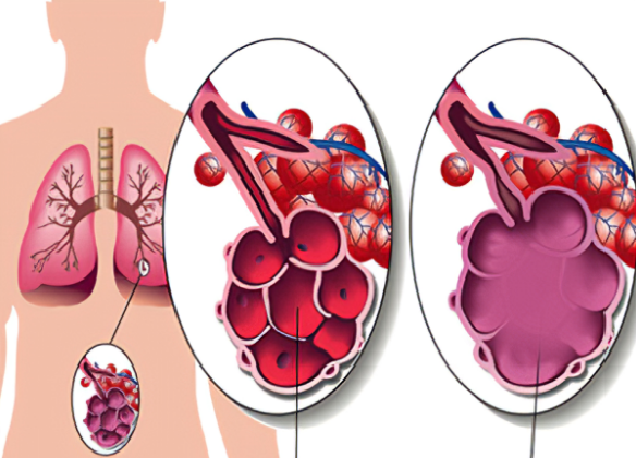 Tìm hiểu về bệnh giãn phế nang - Nguyên nhân, triệu chứng, mức độ nguy hiểm, cách điều trị