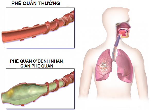 Phế quản ở người khỏe mạnh và ở bệnh nhân giãn phế quản