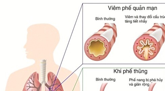 BoniDetox - Mang sức khỏe và niềm vui trở lại với người bệnh viêm phế quản mạn tính