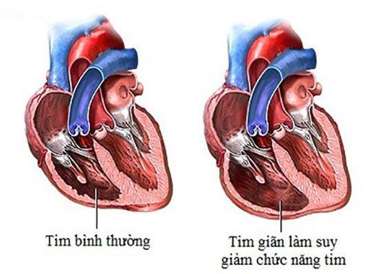 Suy tim phải ở bệnh nhân COPD.