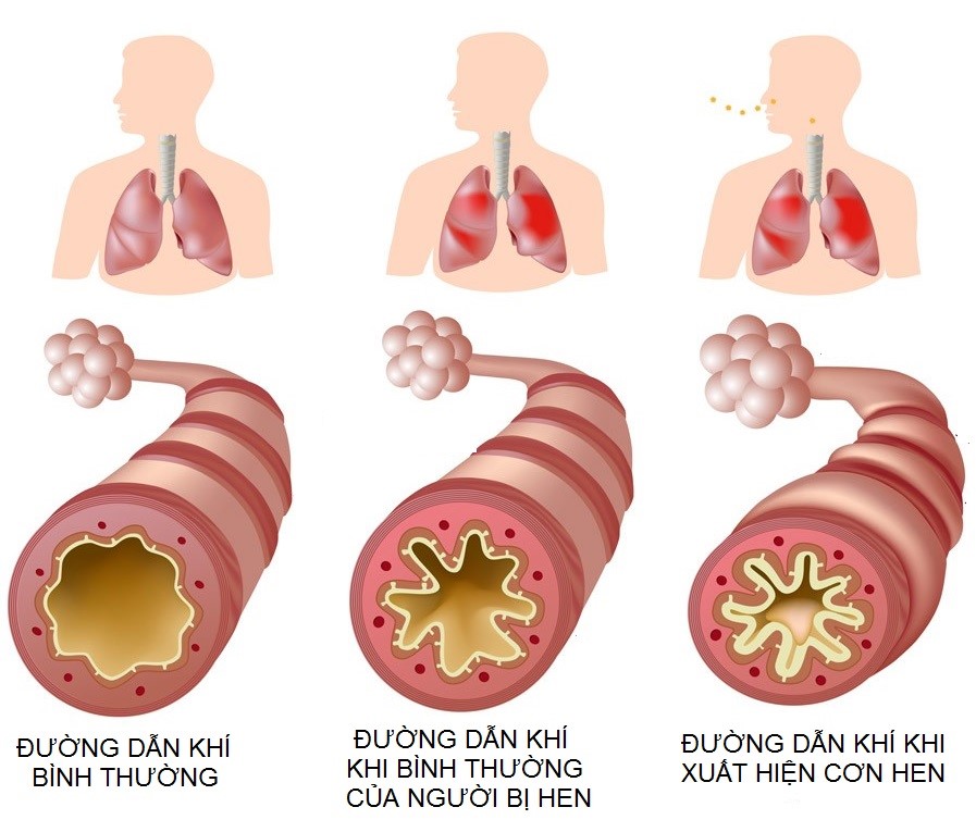 Đường hô hấp bị tắc nghẽn khiến phế nang phải chịu áp lực lớn trong cơn hen cấp