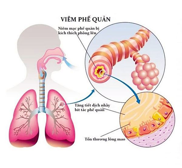 Bệnh lý viêm phế quản cấp