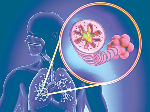 COPD - Nguyên nhân gây tử vong thứ 3 trên thế giới