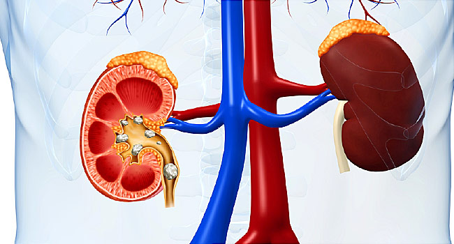 Biến chứng suy thận ở bệnh nhân tiểu đường