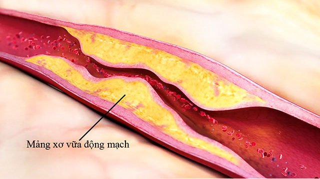  Xơ vữa động mạch là nguyên nhân chính gây ra biến chứng mạch máu lớn