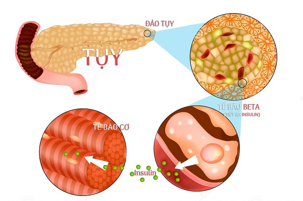 Hệ nội tiết và bệnh tiểu đường có mối quan hệ như thế nào?