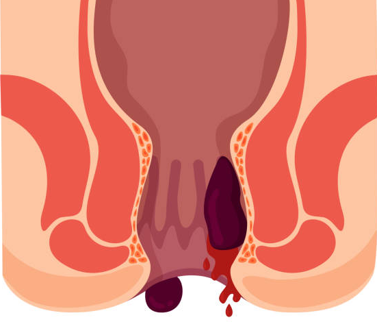 Dấu hiệu nhận biết bệnh trĩ là gì?