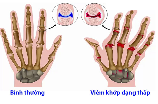 Bệnh viêm khớp dạng thấp dễ nhầm với bệnh gút