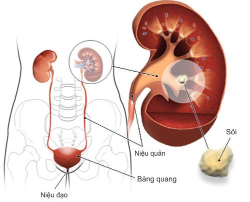 Bệnh Gout có thể dẫn đến suy thận.