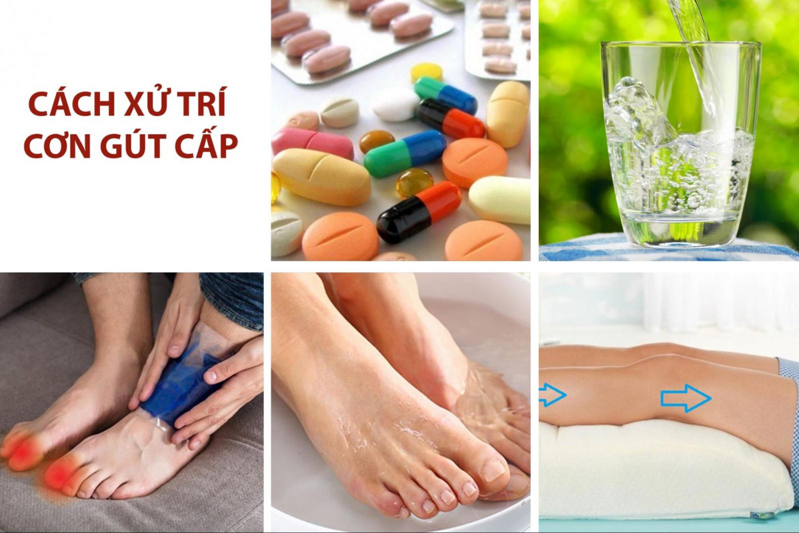 Các cách hỗ trợ xử trí đau gút cấp