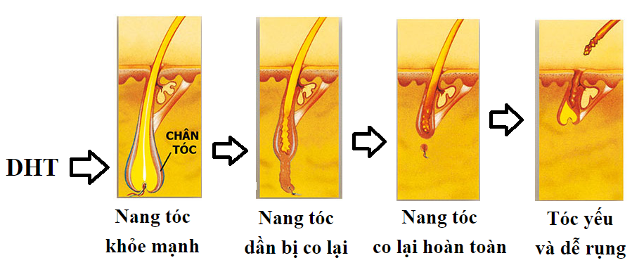 DHT là nguyên nhân chủ yếu gây tình trạng tóc rụng nhiều ở nữ giới