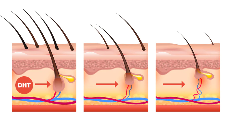 DHT là thủ phạm khiến tóc yếu và dễ gãy rụng