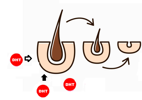 DHT gắn vào nang tóc làm chúng co lại