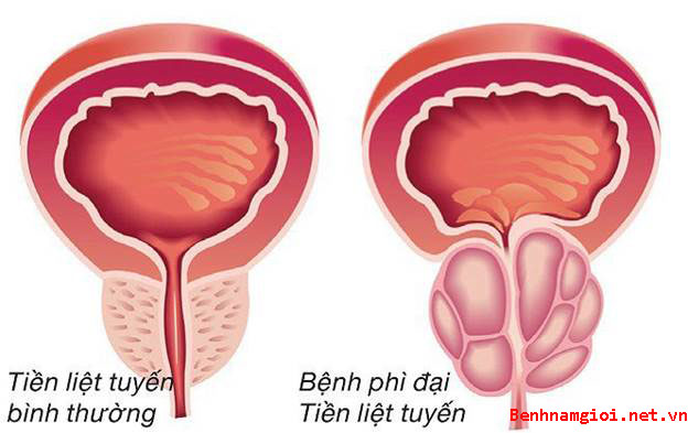 Kích thước tuyến tiền liệt bao nhiêu là an toàn?