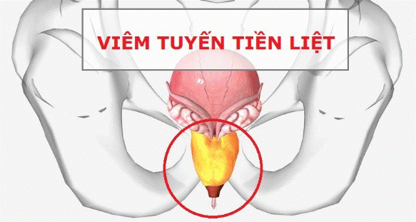 Viêm tuyến tiền liệt ở nam giới