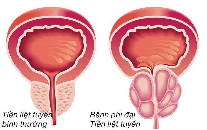 U xơ tuyến tiền liệt là gì?