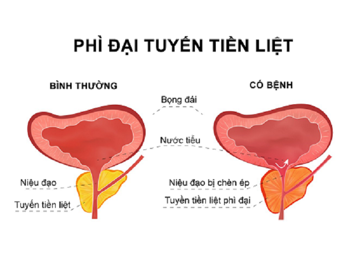 Điều trị phì đại tuyến tiền liệt như thế nào? Tìm hiểu 3 giai đoạn phát triển của bệnh