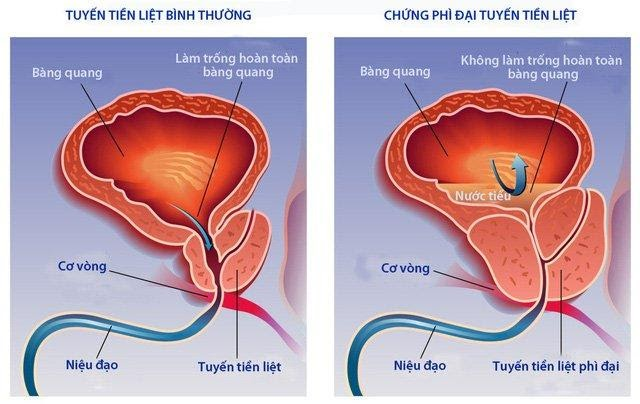 Bệnh phì đại tuyến tiền liệt gây tiểu nhiều lần