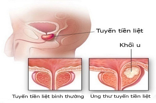 Ung thư tuyến tiền liệt gây tỷ lệ tử vong cao ở nam giới