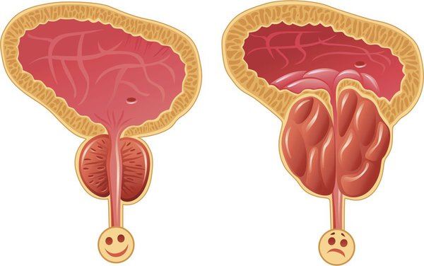 Sử dụng BoniMen giảm được kích thước tiền liệt tuyến rồi có bỏ hẳn được không?