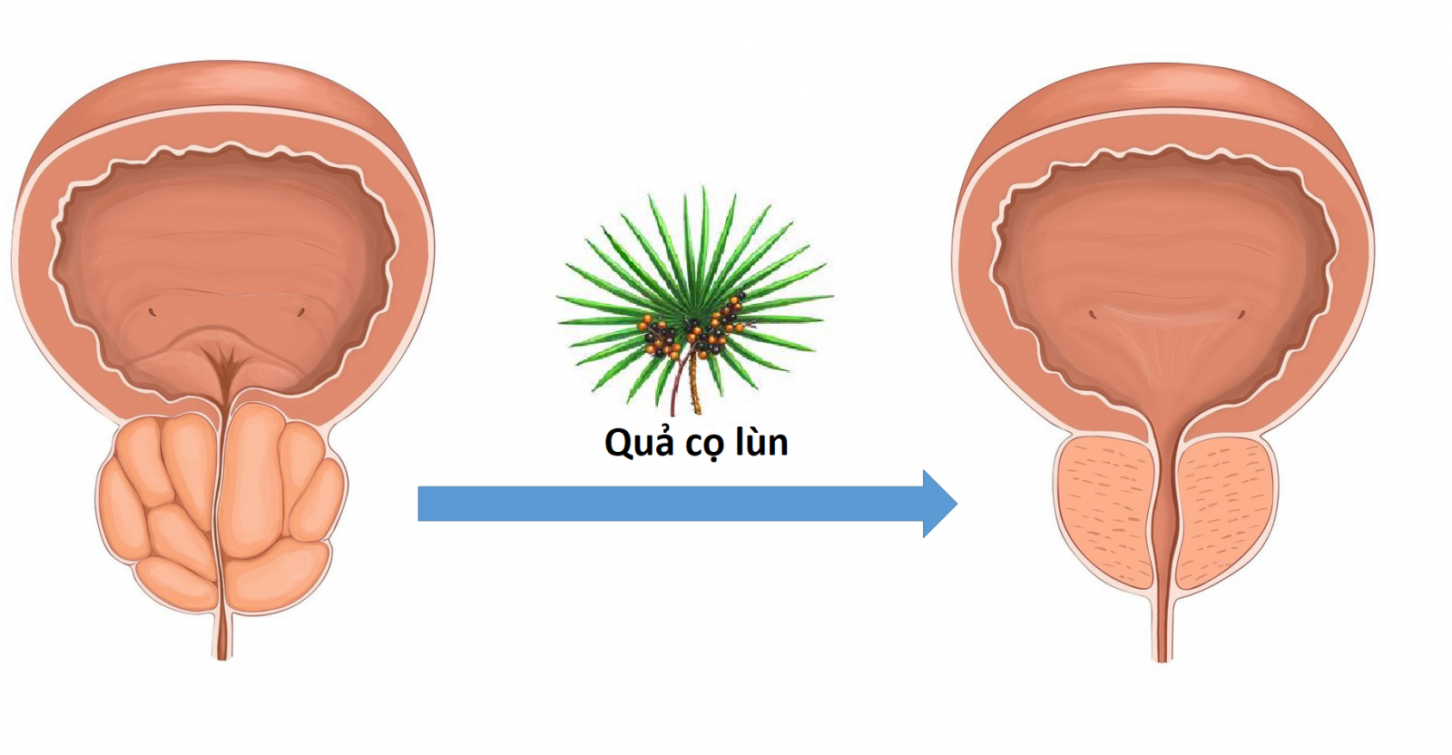 Quả cọ lùn trong BoniMen giúp co nhỏ kích thước tuyến tiền liệt