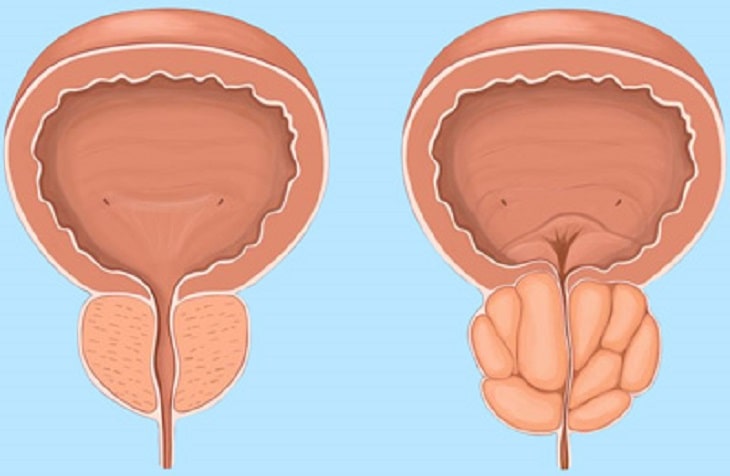 Phì đại tuyến tiền liệt là nguyên nhân hàng đầu gây tiểu rắt ở nam giới