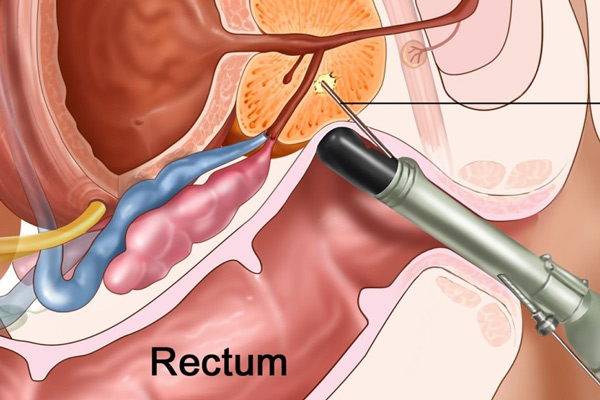 Vai trò của siêu âm trong chẩn đoán và điều trị bệnh phì đại tuyến tiền liệt