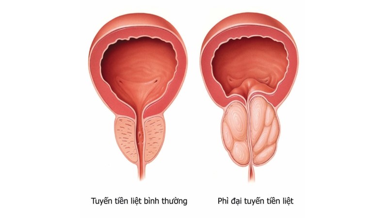 Những biện pháp giúp giảm kích thước phì đại tiền liệt tuyến