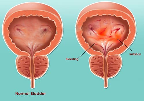 Nguyên nhân viêm bàng quang ở người phì đại tuyến tiền liệt là gì?