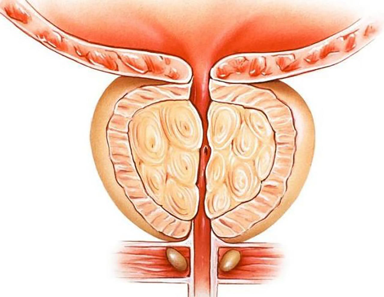 Nguyên nhân hàng đầu gây bệnh phì đại tuyến tiền liệt và cách khắc phục