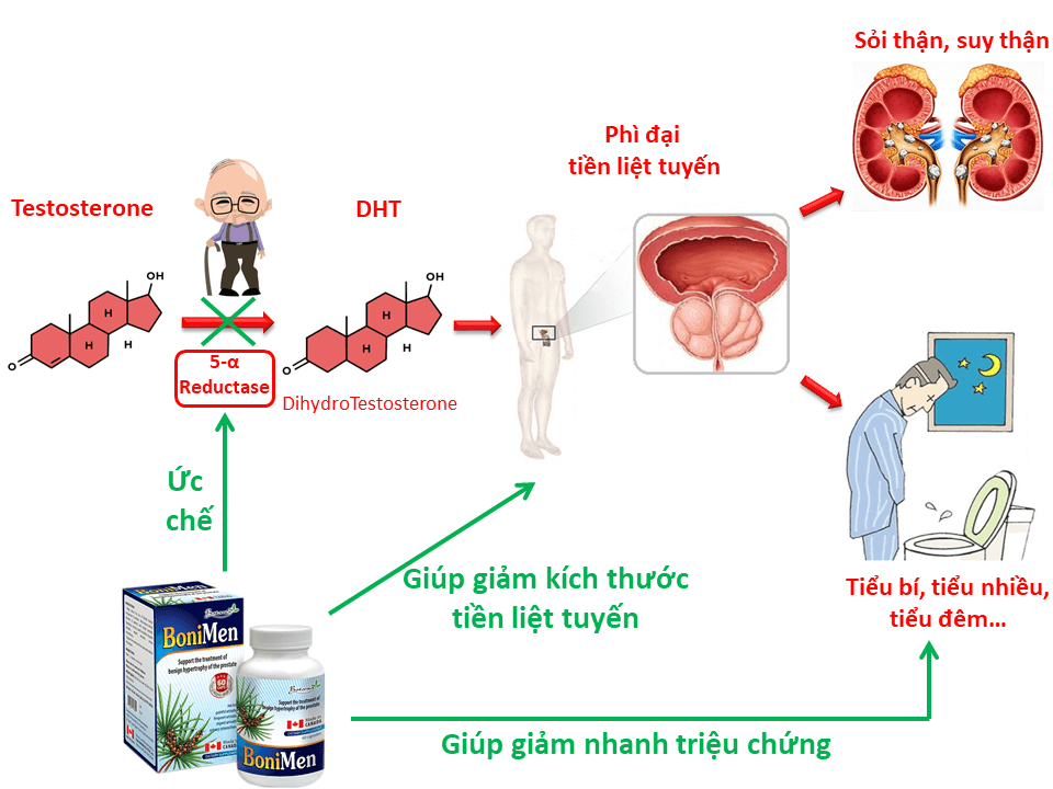 Nguyên nhân u xơ tuyến tiền liệt là do đâu?