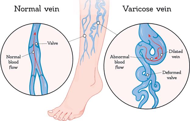 9 nguyên nhân chính gây suy giãn tĩnh mạch và cách khắc phục