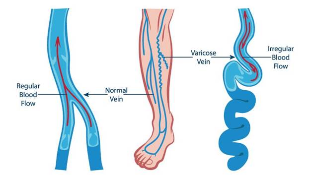 Hình ảnh tĩnh mạch khỏe mạnh và tĩnh mạch bị suy giãn