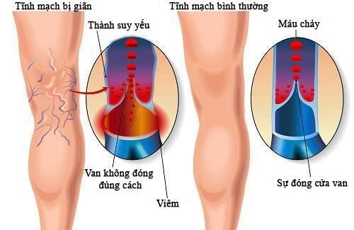 Các biện pháp điều trị suy giãn tĩnh mạch chân phổ biến