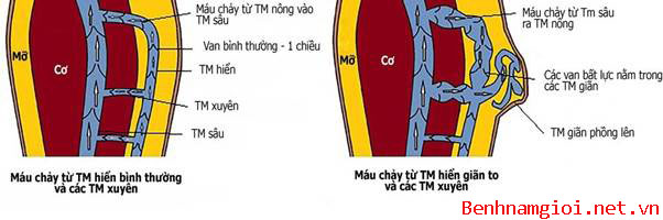 Tìm hiểu về biến chứng huyết khối tĩnh mạch do mắc suy van tĩnh mạch sâu