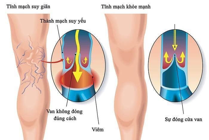 Những điều cần biết về bệnh lý suy van tĩnh mạch