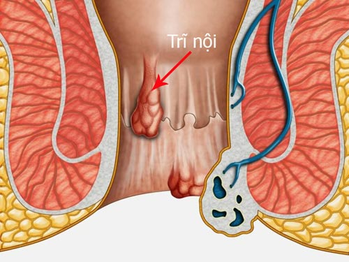 Trĩ nội độ 2 có chữa được không? 3 Giải pháp điều trị bệnh trĩ nội độ 2