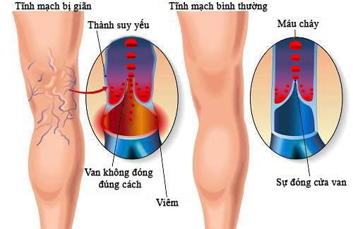  Suy giãn tĩnh mạch gây nổi gân tím ở chân