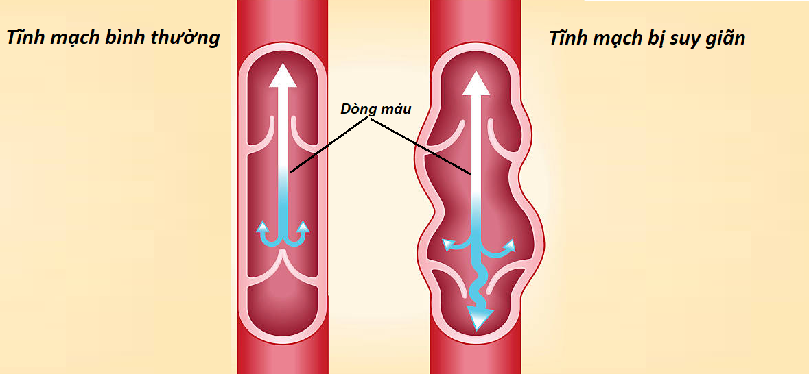 Dòng máu trong tĩnh mạch bình thường và tĩnh mạch bị suy giãn