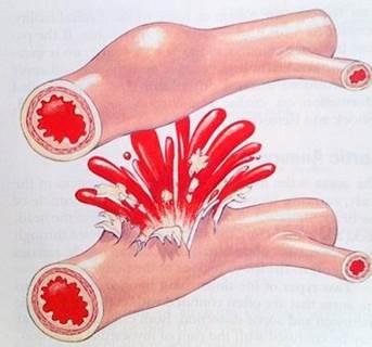 Biến chứng vỡ tĩnh mạch