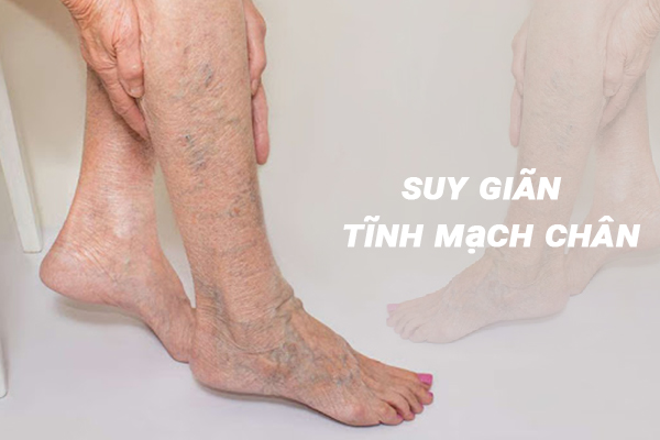 Suy giãn tĩnh mạch chân gây ra những ảnh hưởng gì với người bệnh?