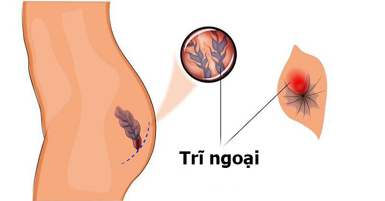 Biểu hiện triệu chứng của bệnh trĩ ngoại