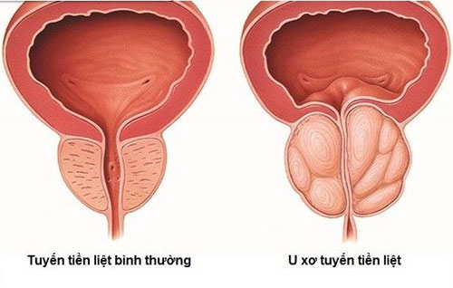 Phì đại tuyến tiền liệt ảnh hưởng đến chuyện vợ chồng