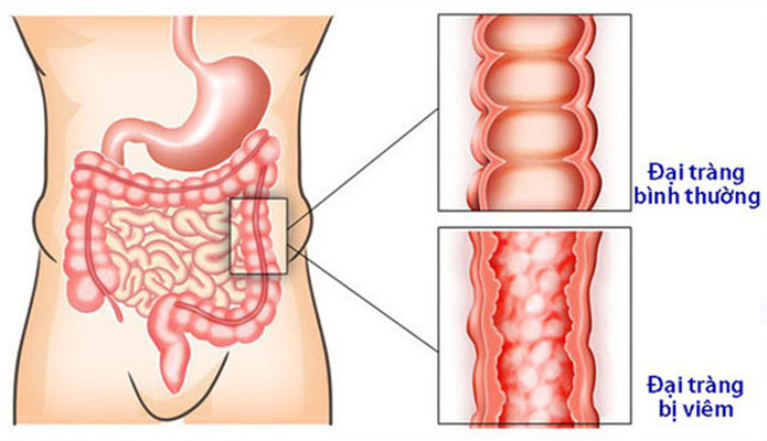 Người bệnh viêm đại tràng bị đi ngoài nhiều lần trong ngày