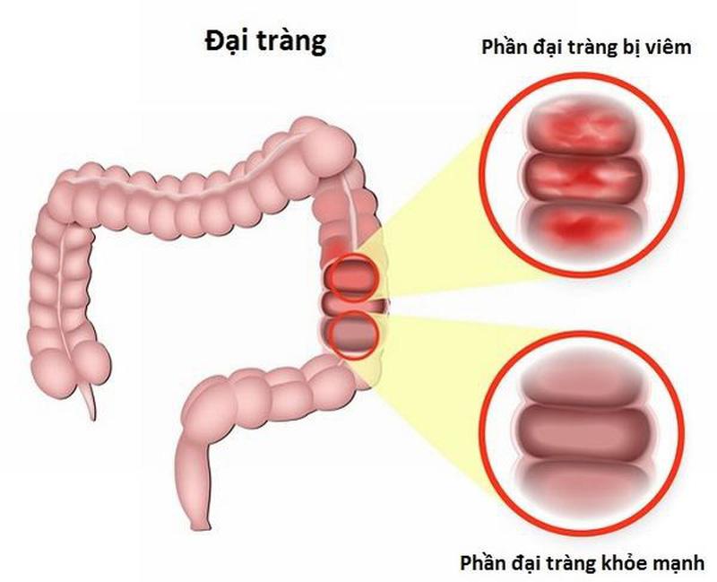 Viêm đại tràng mãn tính nên sử dụng nghệ đen hay nghệ vàng?