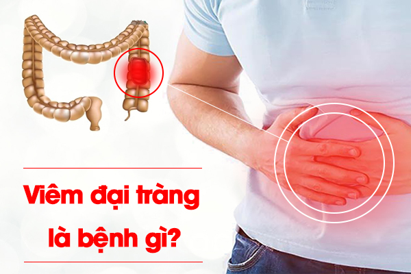 Viêm đại tràng là bệnh gì?