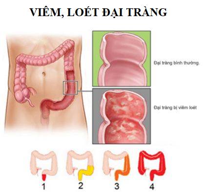 Chuyên gia mách bạn: “Bệnh viêm đại tràng nên ăn gì?”