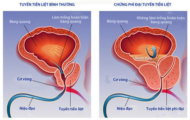 Điều trị phì đại tuyến tiền liệt như thế nào?